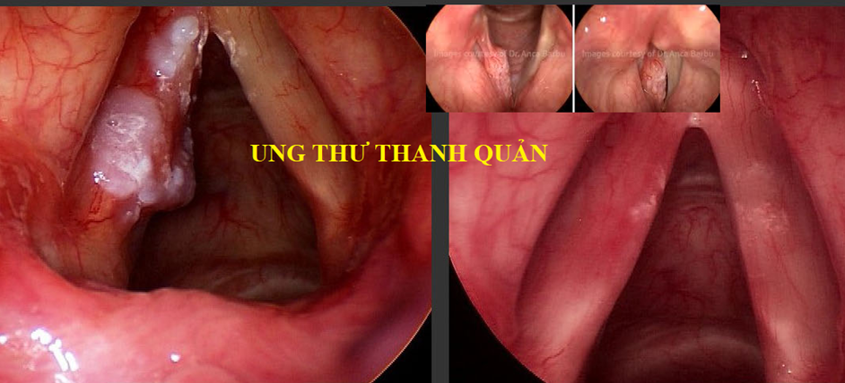 Đối phó ra sao với khàn tiếng? -0