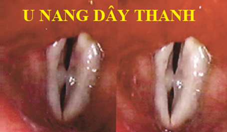 Đối phó ra sao với khàn tiếng? -0
