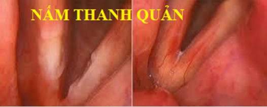 Đối phó ra sao với khàn tiếng? -0