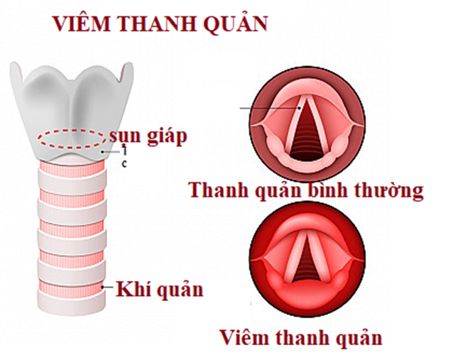 Đối phó ra sao với khàn tiếng? -0