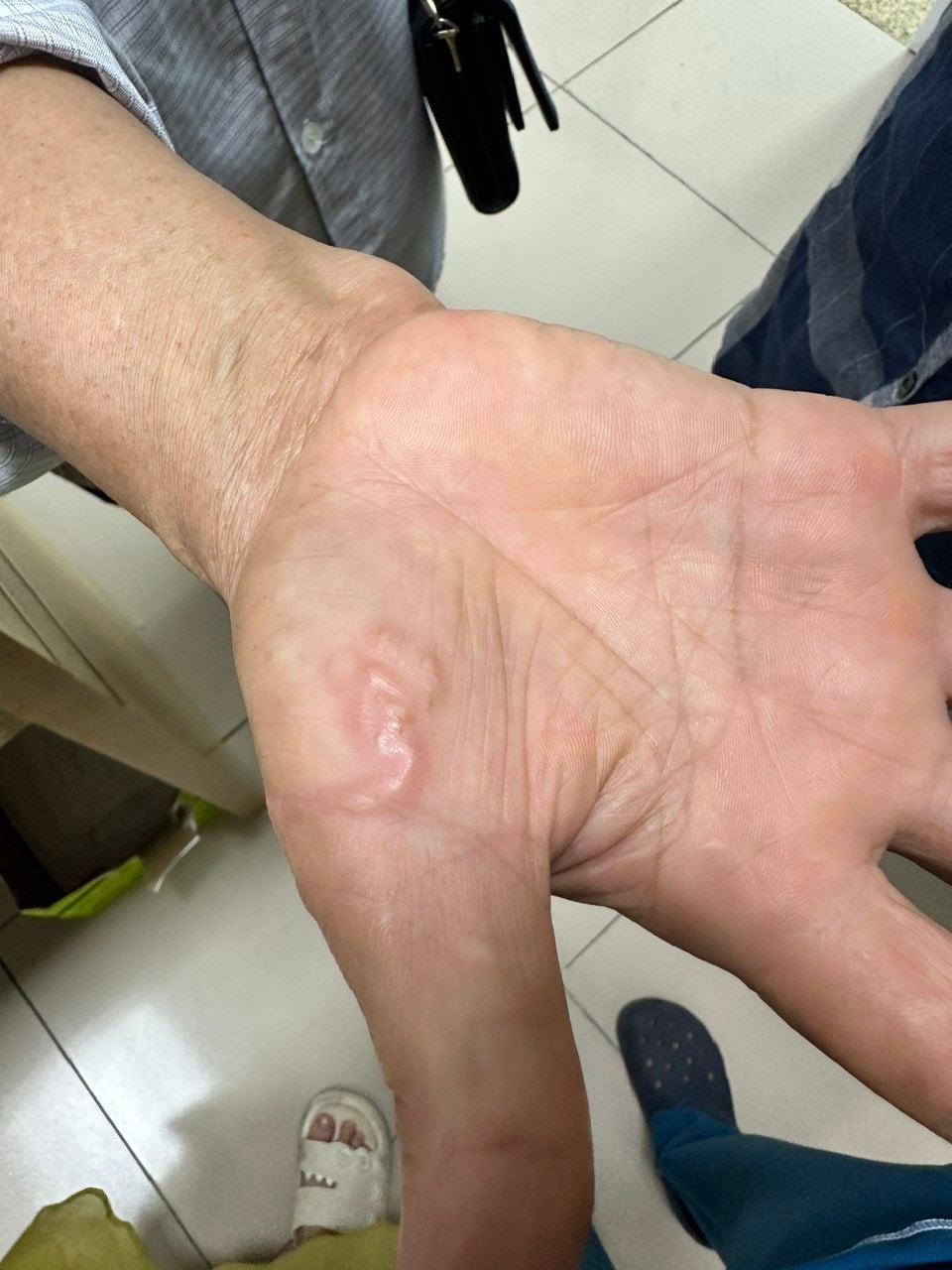 Ký sinh trùng chạy ngoằn nghèo dưới da người phụ nữ nuôi 8 con chó mèo -0