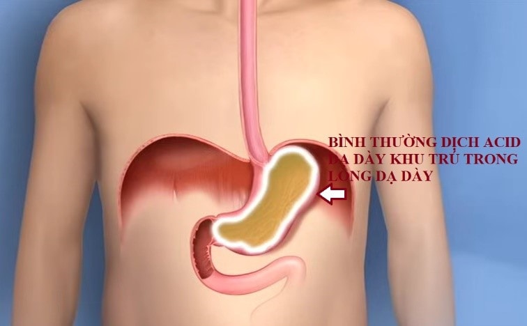 Ảnh hưởng của trào ngược tới họng - thanh quản -0