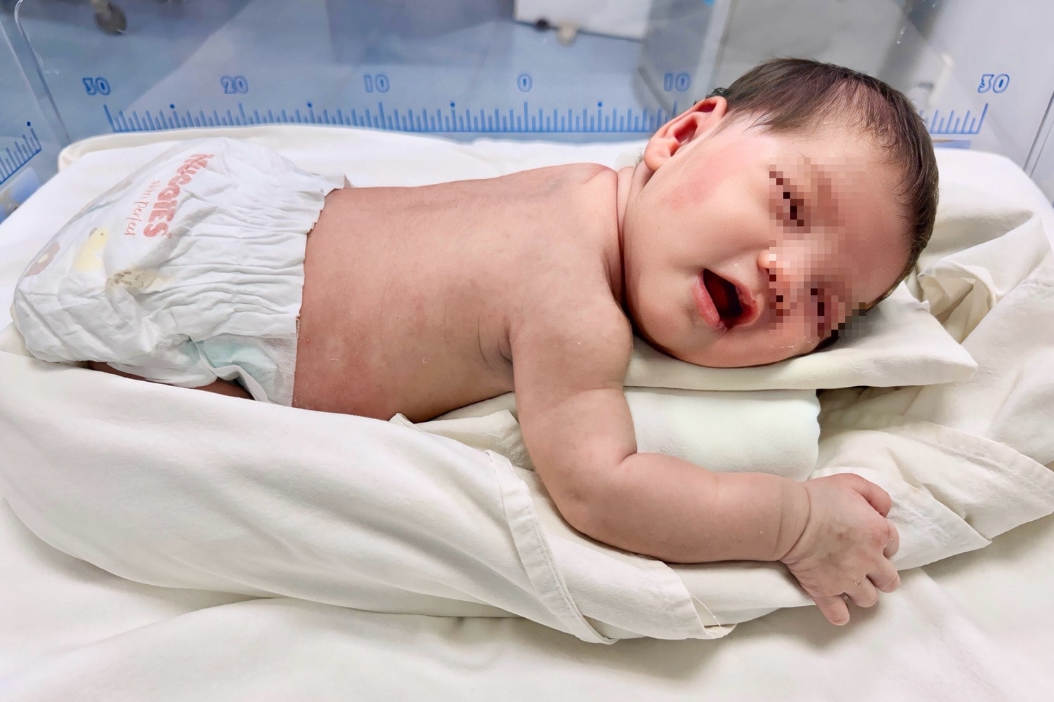 Hành trình 1 tháng cứu sống bé sơ sinh bị bỏ rơi ven đường với hàng trăm con giòi bò khắp cơ thể -0