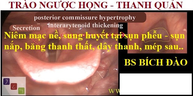 Ảnh hưởng của trào ngược tới họng - thanh quản -0