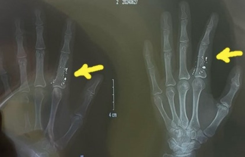 Nhiễm độc thuỷ ngân từ vật dụng quen thuộc, bác sĩ cảnh báo -0