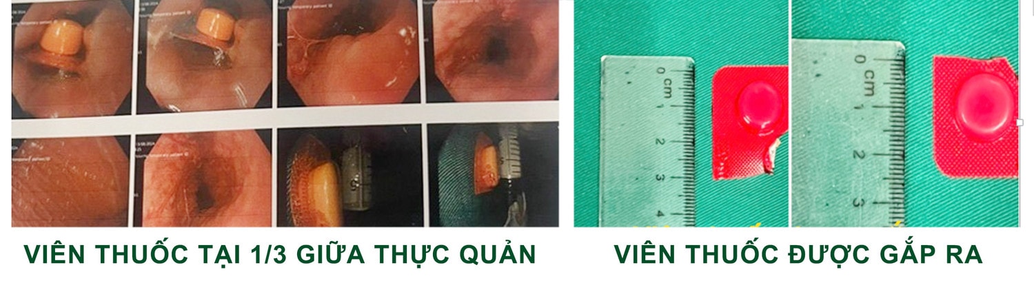 Cảnh giác với dị vật thuốc nguyên vỏ trong đường tiêu hóa -0