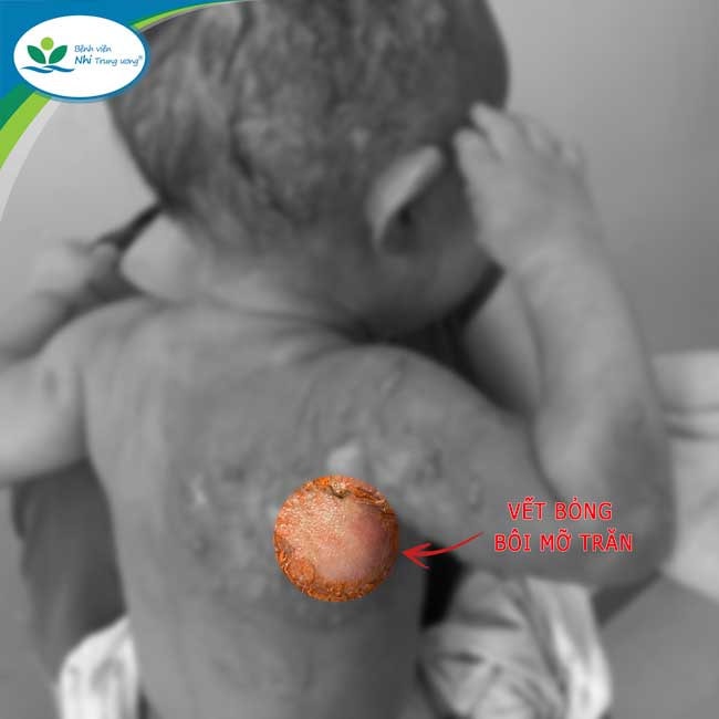 Bôi mỡ chăn vào vùng bỏng nước canh, trẻ 12 tháng tuổi trở nặng -0
