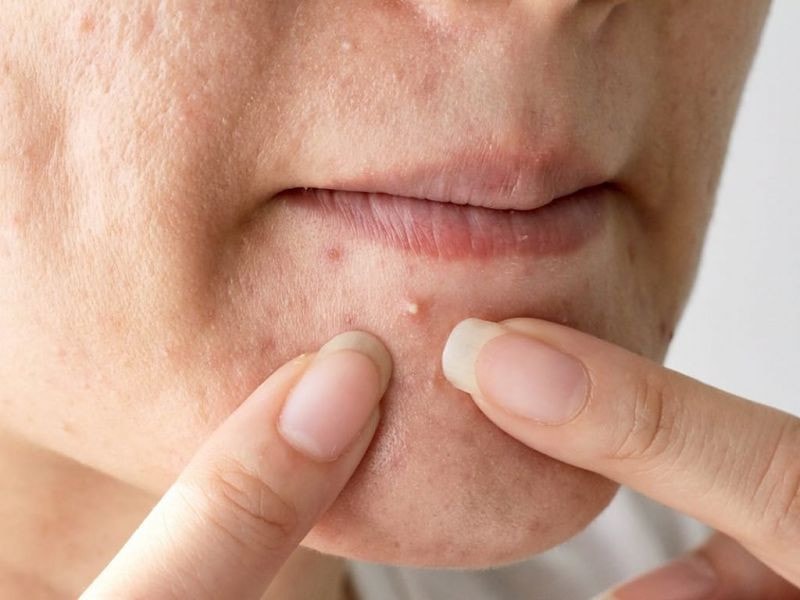 Tự nặn mụn mủ trên mặt có thể dẫn tới nhiễm khuẩn huyết, bác sĩ cảnh báo -0