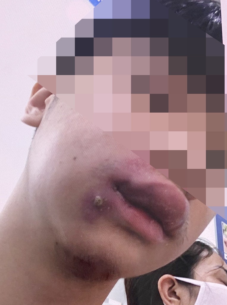 Tự nặn mụn mủ trên mặt có thể dẫn tới nhiễm khuẩn huyết, bác sĩ cảnh báo -0