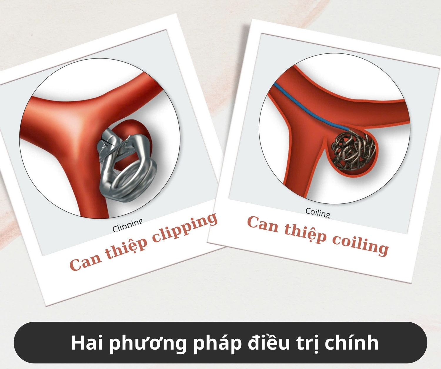 Phình mạch não đe doạ tính mạng người trẻ -0