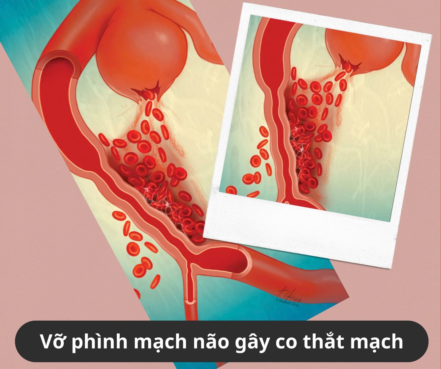 Phình mạch não đe doạ tính mạng người trẻ -0
