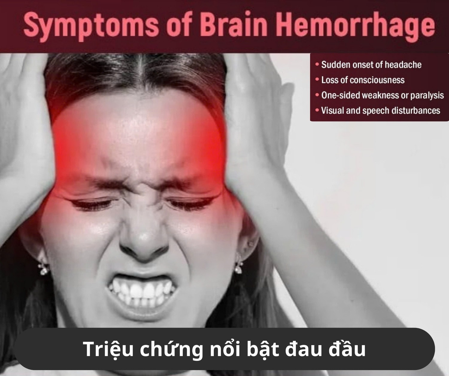 Phình mạch não đe doạ tính mạng người trẻ