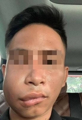 Nhiễm trùng vùng mặt sau cấy chỉ, bác sĩ cảnh báo -0