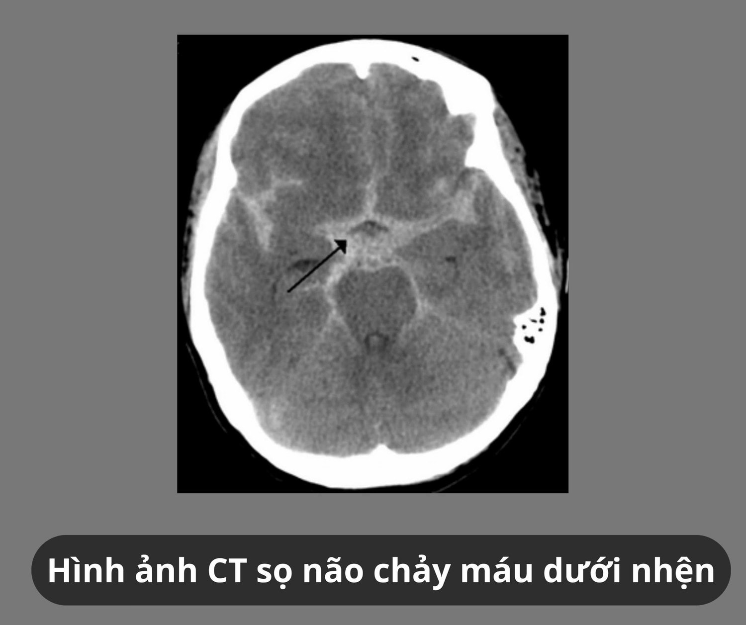 Chảy máu dưới nhện là biến chứng nguy hiểm của vỡ phình mạch não -0