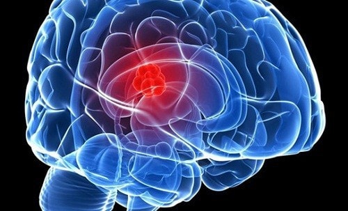 U não và những triệu chứng không thể bỏ qua -0