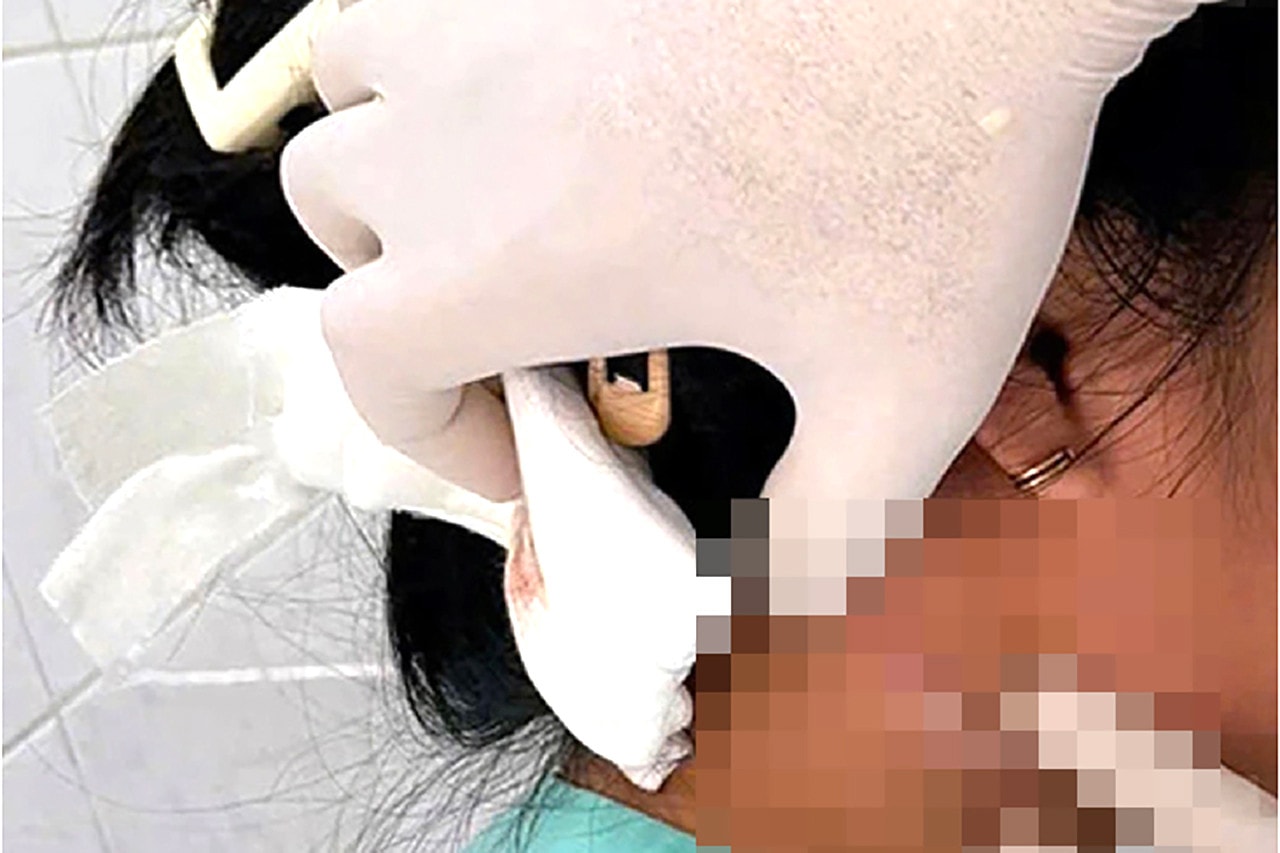Xuất hiện ca bệnh nhiễm “vi khuẩn ăn thịt người” Whitmore đầu tiên tại Đồng Nai -0