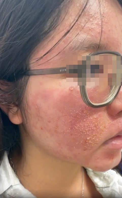 Xuất hiện mụn viêm, chảy mủ khắp mặt vì tin quảng cáo “hết mụn sau 7 ngày” -0