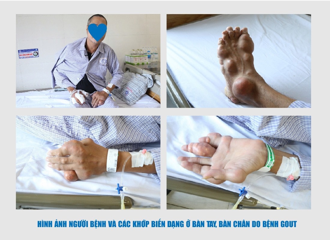 GOUT-01.jpg