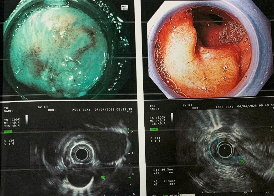 Hình ảnh nội soi, siêu âm nội soi dạ dày thực quản cho thấy ung thư hai vị trí ở giai đoạn tương đối sớm