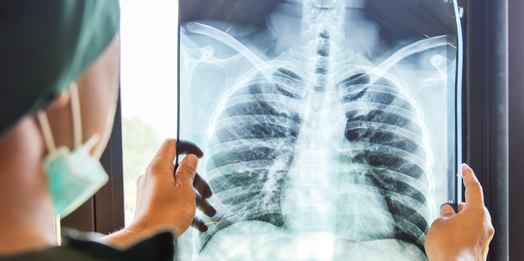 lung cancer