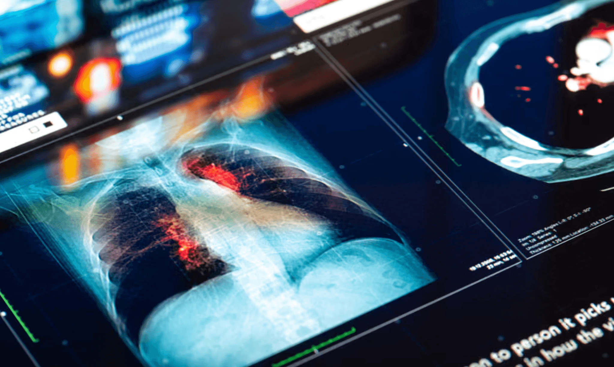 lung cancer