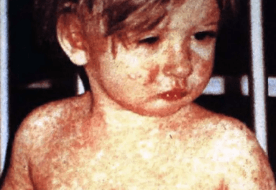 us measles 1