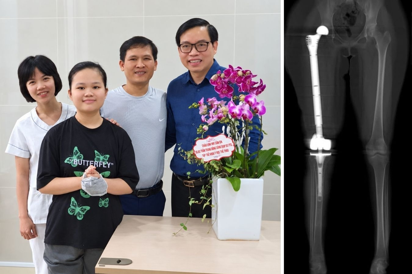 GS.TS.BS Trần Trung Dũng bên Linh Nhi và gia đình (trái) và ca đại phẫu thay toàn bộ xương đùi Titan in 3D năm 2021 (phải)