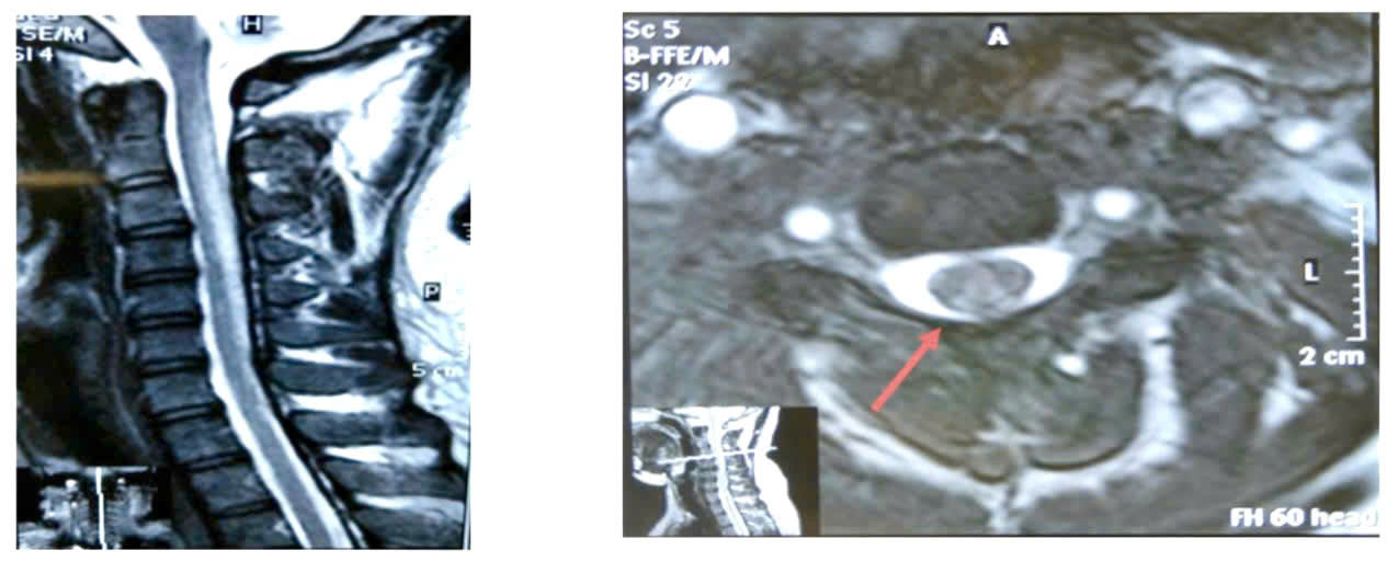 Hình ảnh tổn thương trên MRI cột sống cổ