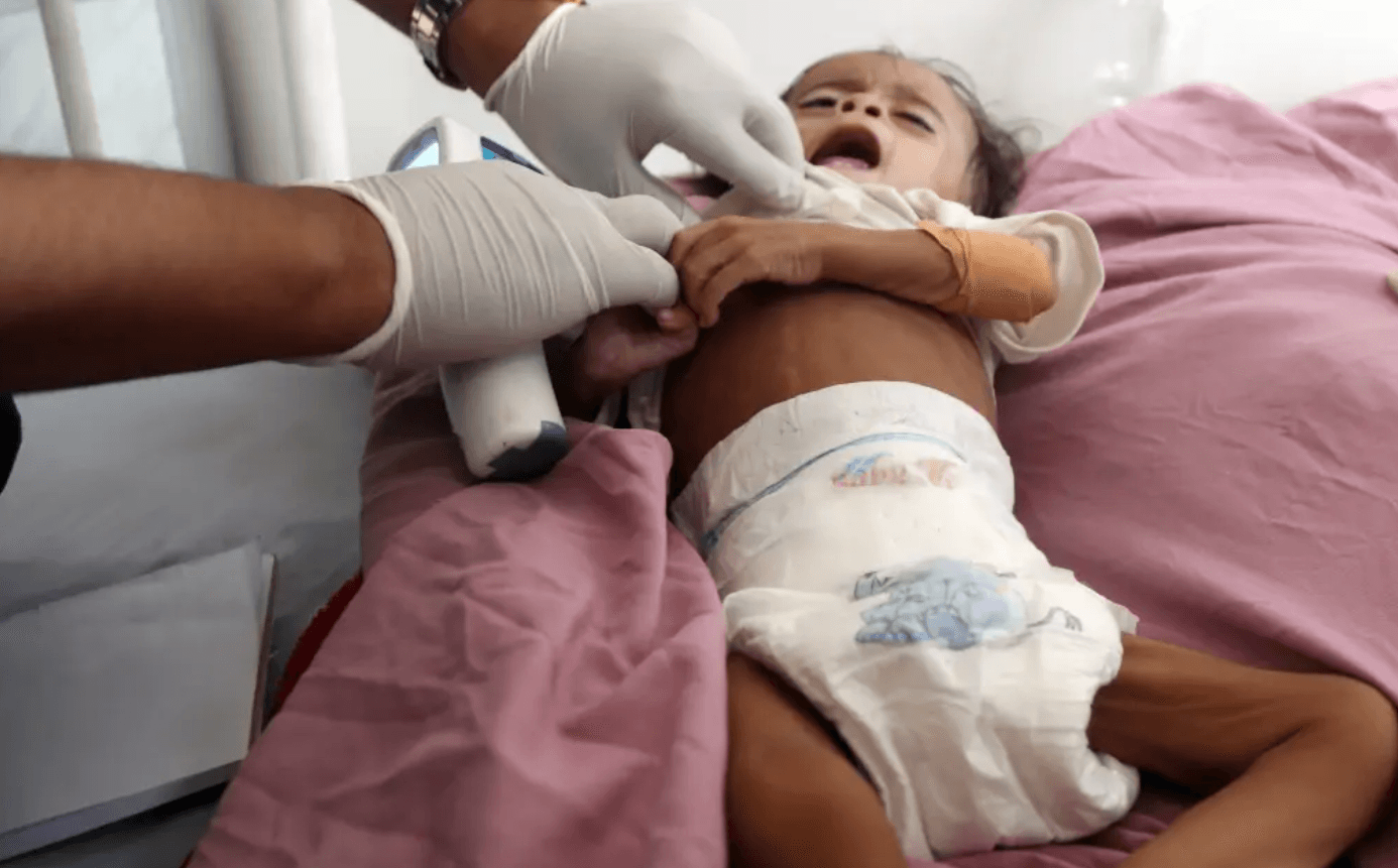Suy dinh dưỡng là nguyên nhân gây ra gần 45% tổng số ca tử vong ở trẻ em dưới 5 tuổi trên toàn thế giới