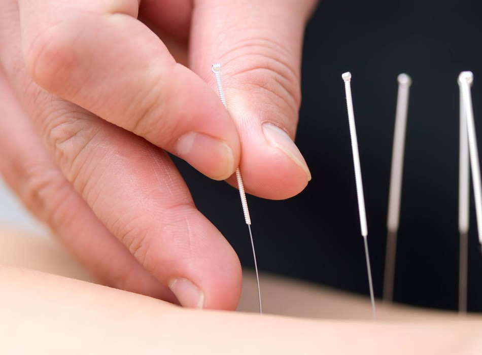 Theo hướng dẫn chuyên môn của Bộ Y tế, châm cứu được sử dụng trong điều trị mất ngủ không thực tổn, với liệu trình thường từ 15–20 ngày tùy thể bệnh, mỗi lần lưu kim khoảng 20–30 phút. Ảnh minh họa