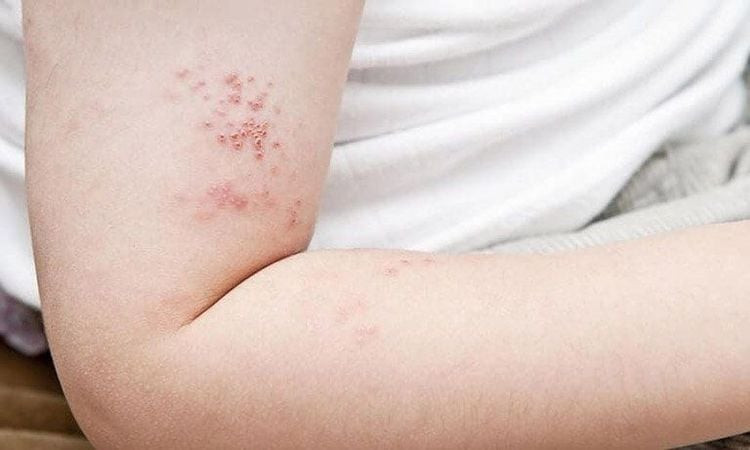 Cảnh báo biến chứng zona thần kinh: Những dấu hiệu dễ bị bỏ sót