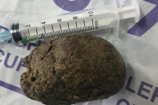 Nữ bệnh nhân nhập viện tắc ruột sau khi ăn trái hồng ngâm