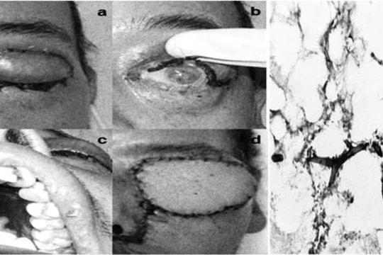 Người đàn ông bị áp xe phổi, hoại tử não vì nhiễm nấm đen
