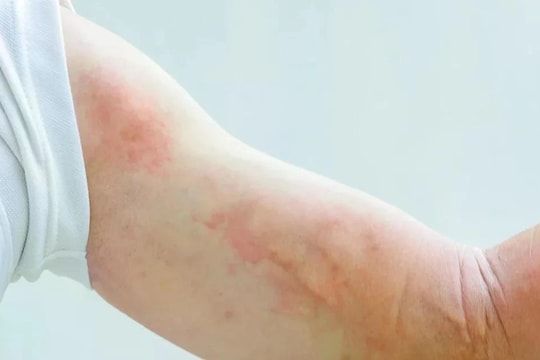 Triệu chứng và cách phòng ngừa mày đay mùa lạnh