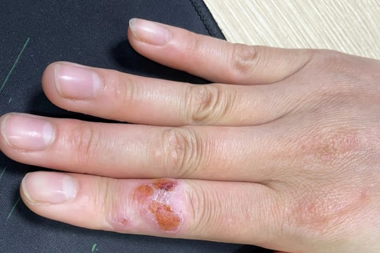 Người đàn ông mắc bệnh lạ từ thú vui chơi cá cảnh