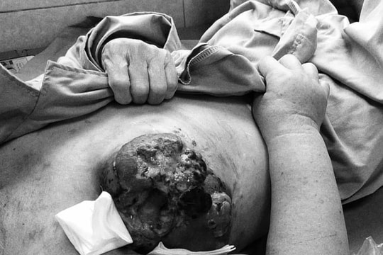 Đắp thuốc nam điều trị ung thư vú, người bệnh hoại tử nặng