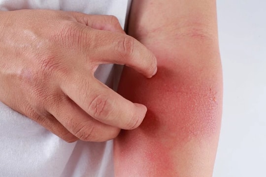 Những loại bệnh dị ứng thời tiết thường gặp