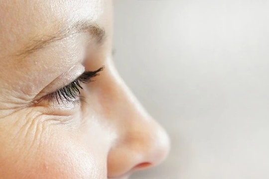 Cần làm gì để loại bỏ vết chân chim ở mắt ?