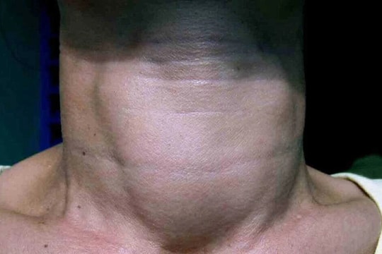 Thiếu Iod - nguyên nhân hàng đầu gây ra khuyết tật trí tuệ