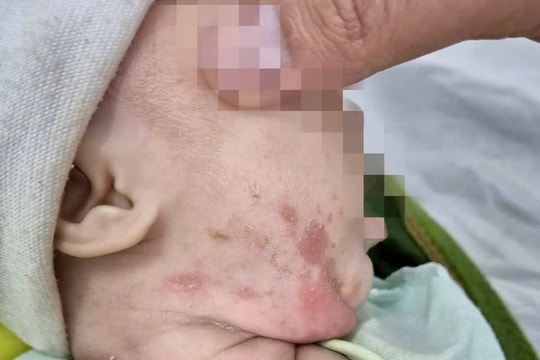 Bé gái 2 tháng tuổi mắc giang mai lây từ mẹ