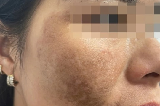 Trị nám cấp tốc tại spa để đón Tết, người phụ nữ bỏng toàn bộ khuôn mặt