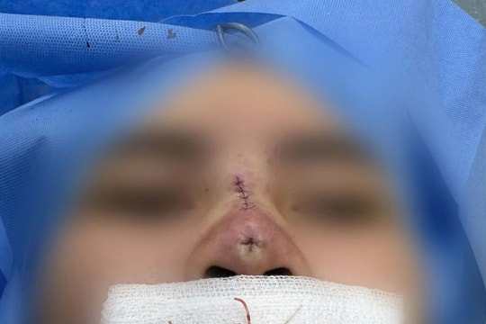 Người phụ nữ bị thủng mũi, biến dạng sau khi làm đẹp tại một spa kém chất lượng