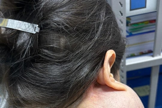 Trì hoãn 14 năm không điều trị, người phụ nữ suýt mất mạng vì khối u khổng lồ trên mặt