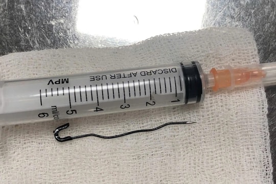 Nuốt phải kim băng sắc nhọn, bé trai 25 tháng tuổi suýt thủng nội tạng