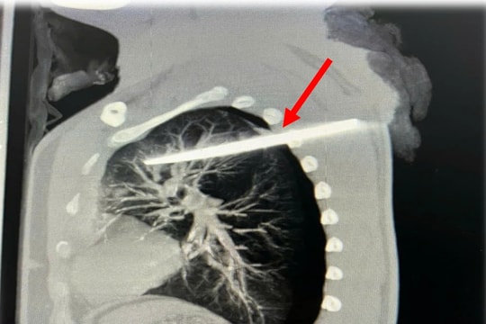Cấp cứu kịp thời người đàn ông nguy kịch do vết thương thấu ngực, kèm dị vật sâu trong phổi