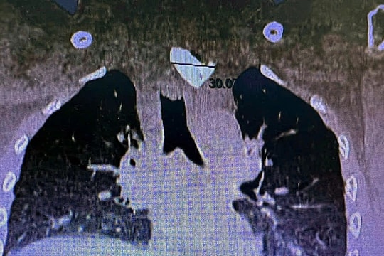 Gắp thành công dị vật đường ăn lớn, cứu sống bệnh nhân 26 tuổi