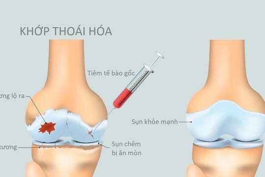 Mối tương quan giữa thoái hóa khớp gối và thừa cân, béo phì