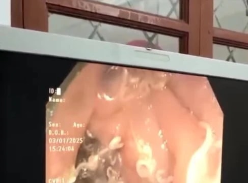 Kinh hãi khi hàng trăm con giun bám trắng ruột người phụ nữ