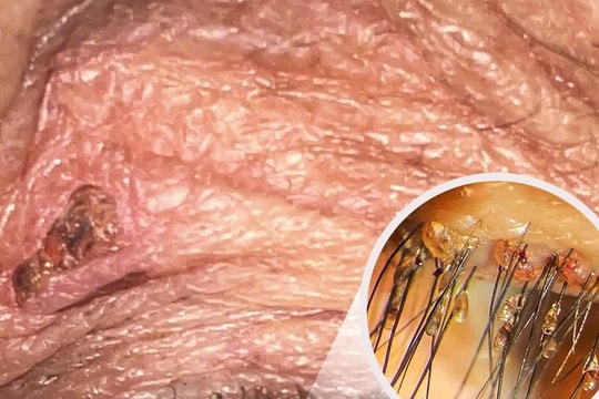 Hy hữu: Hàng trăm con rận mu làm tổ trên mi mắt người đàn ông