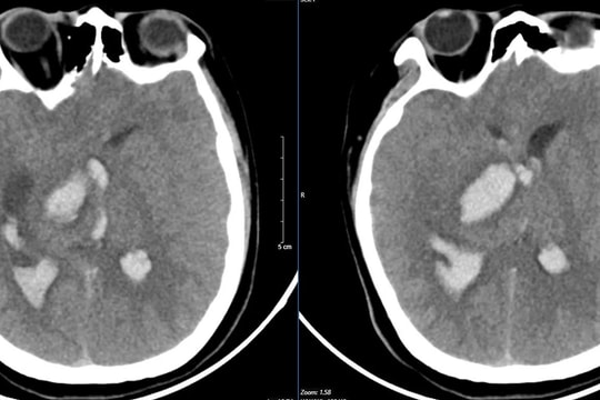 Nam sinh 15 tuổi tử vong sau cơn đau đầu dữ dội, bác sĩ cảnh báo